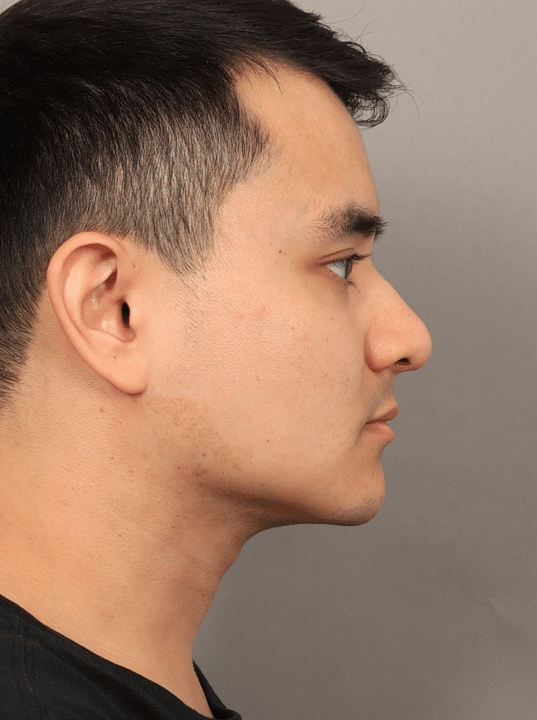 Renuvion Before & After