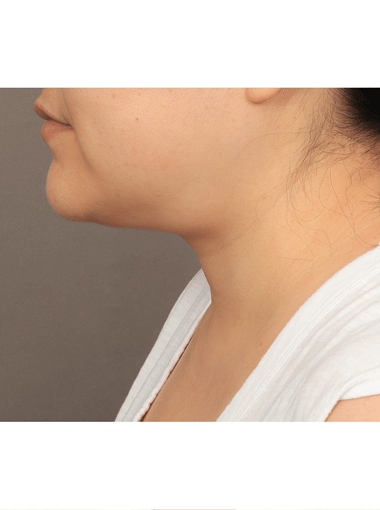 Renuvion Before & After