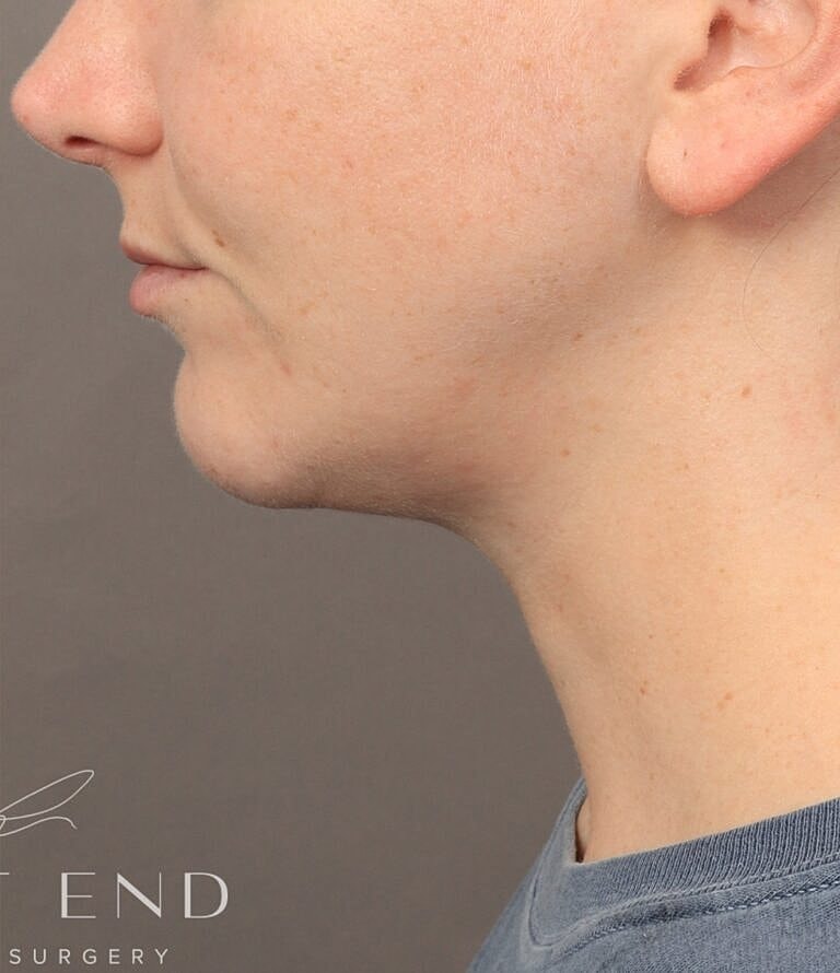 Renuvion Before & After