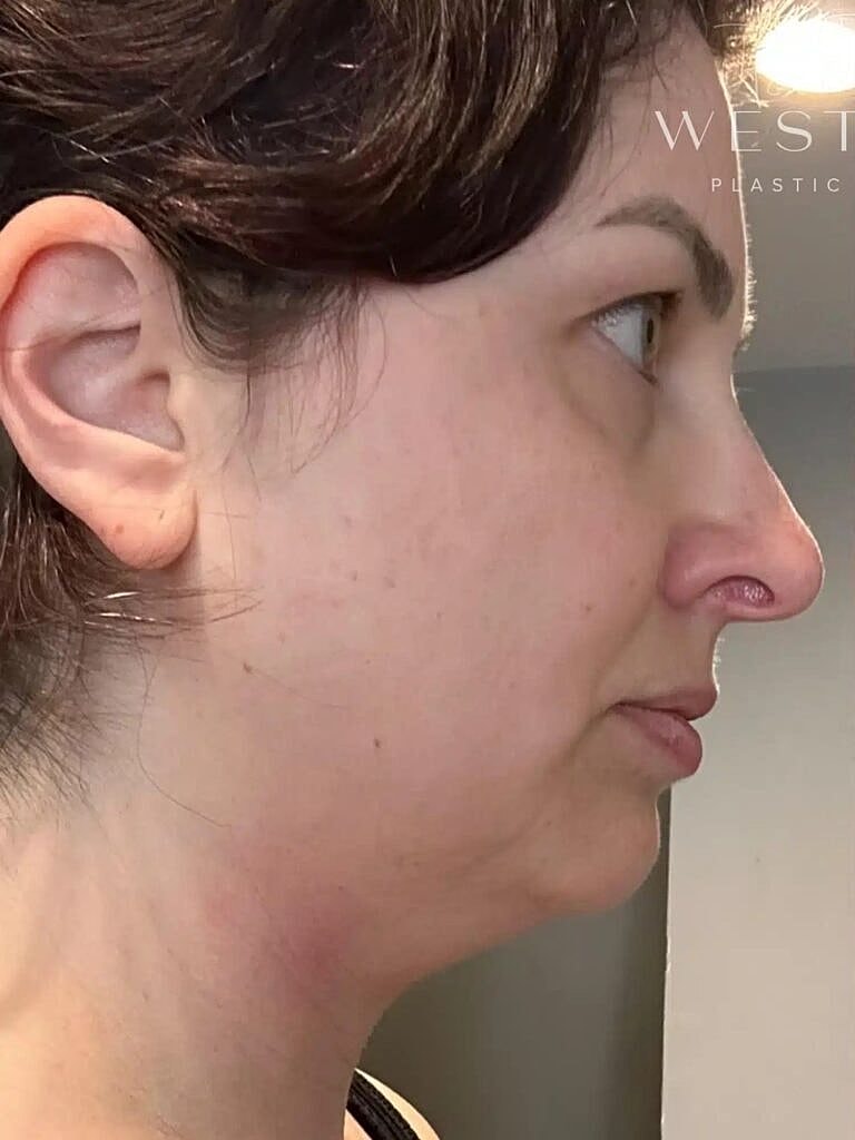 Renuvion Before & After
