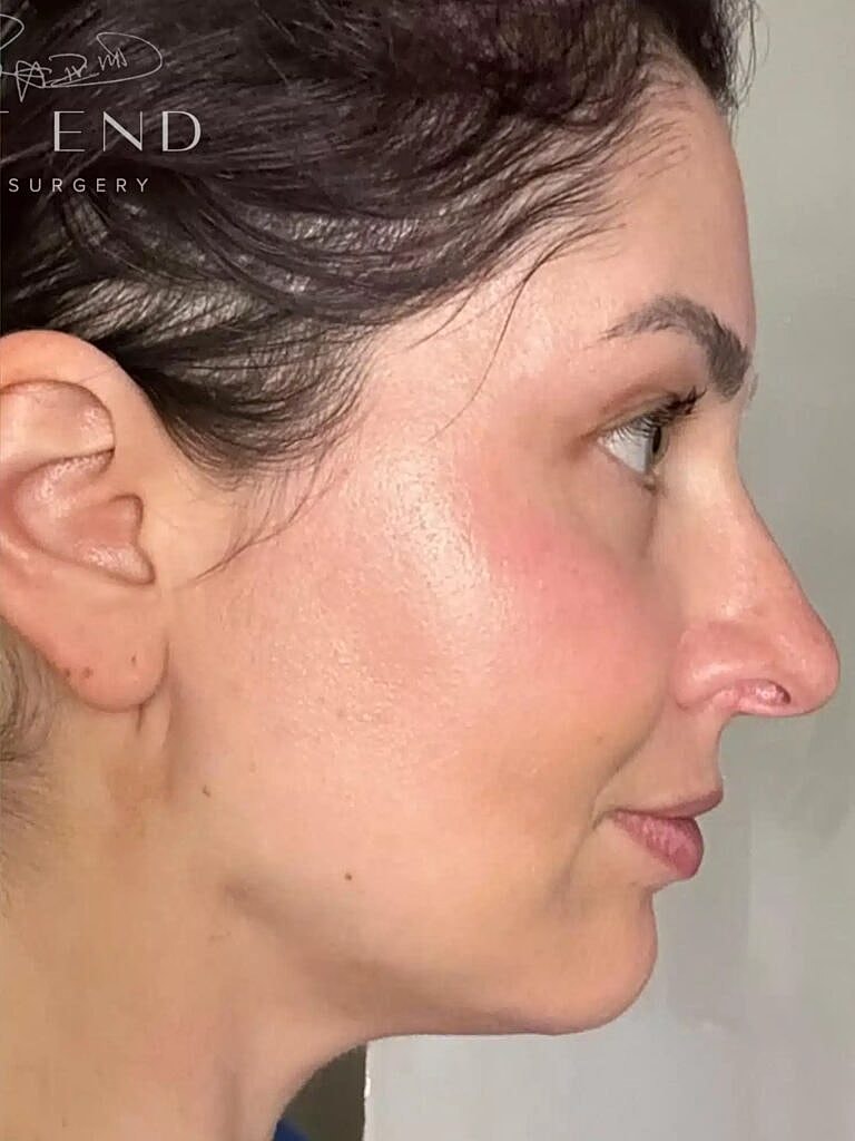 Renuvion Before & After