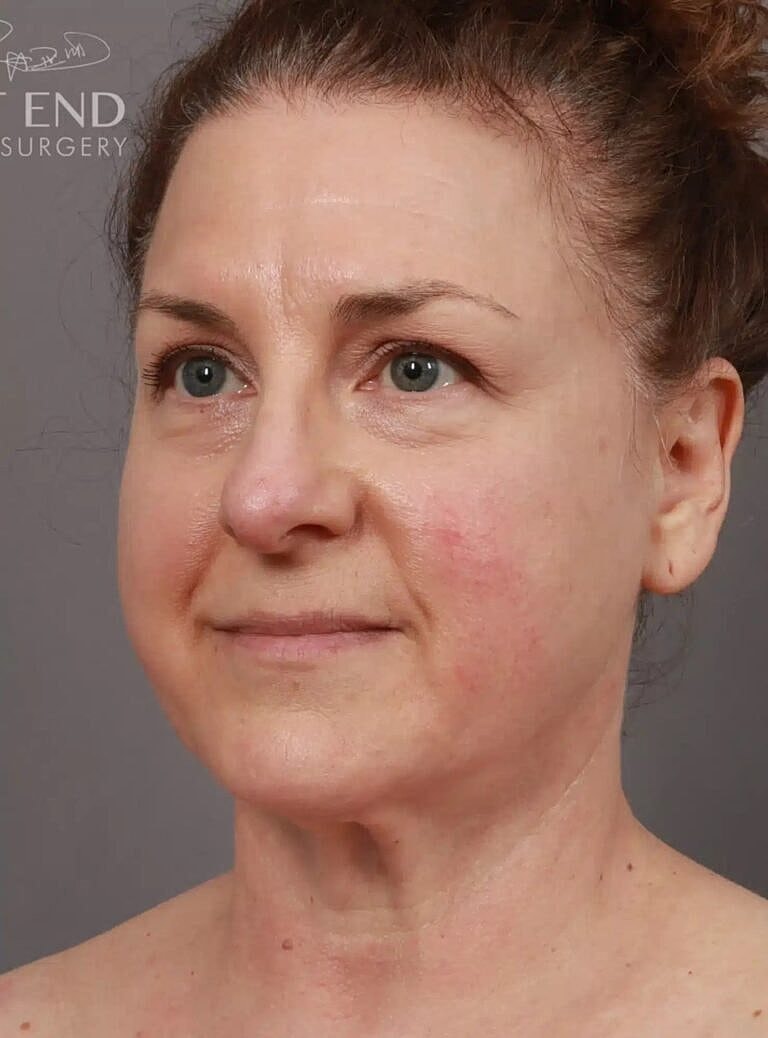 Renuvion Before & After