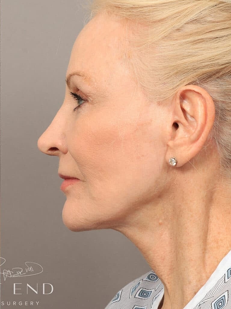 Renuvion Before & After