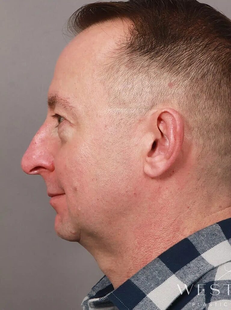 Renuvion Before & After