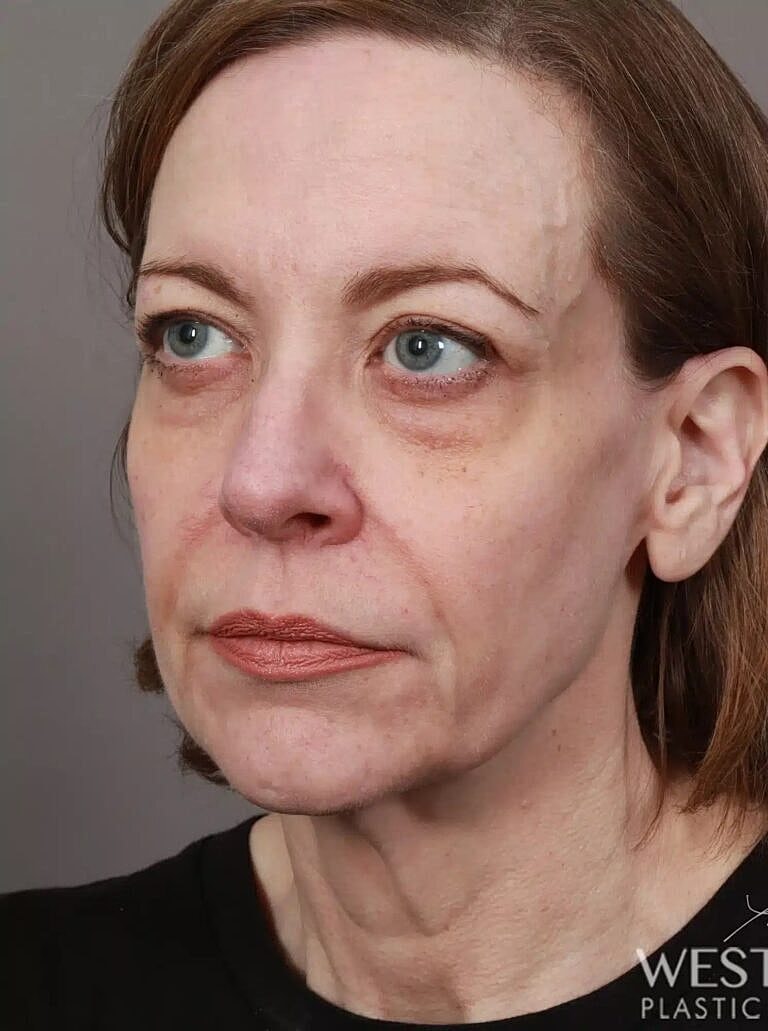 Renuvion Before & After