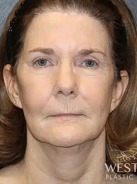 Renuvion Before & After