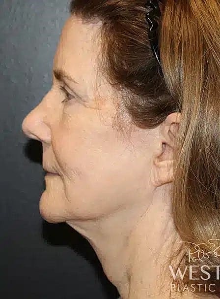 Renuvion Before & After