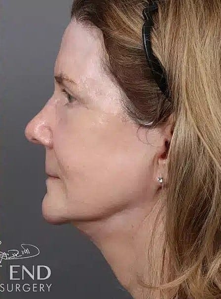 Renuvion Before & After
