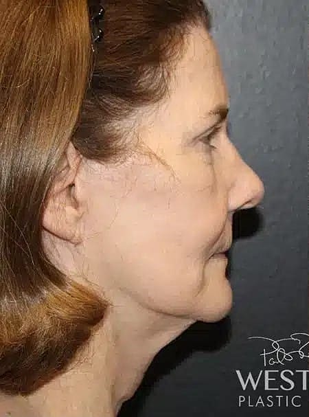 Renuvion Before & After