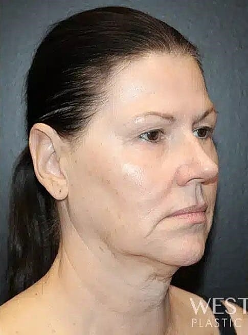 Renuvion Before & After