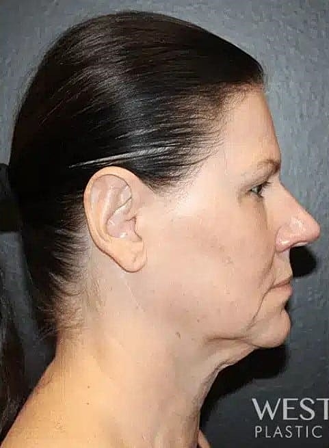 Renuvion Before & After