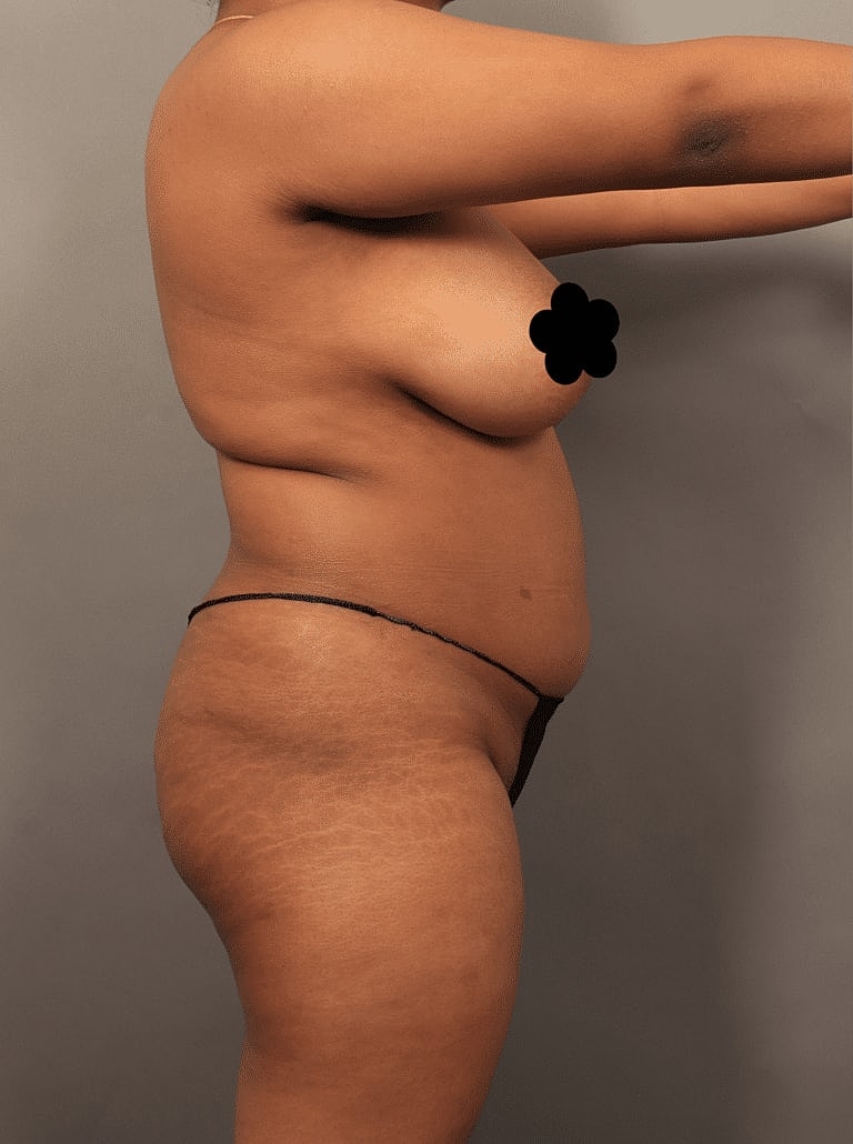Brazilian Butt Lift Before & After