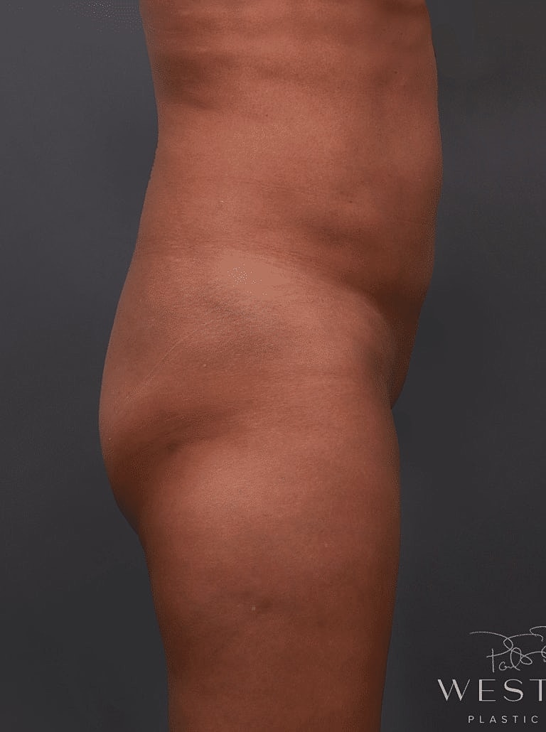 Brazilian Butt Lift Before & After