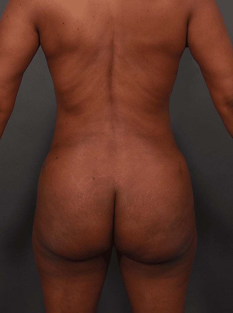 Brazilian Butt Lift Before & After