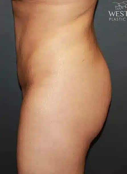 Brazilian Butt Lift Before & After