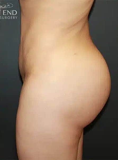 Brazilian Butt Lift Before & After