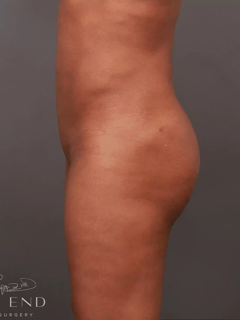 Brazilian Butt Lift Before & After