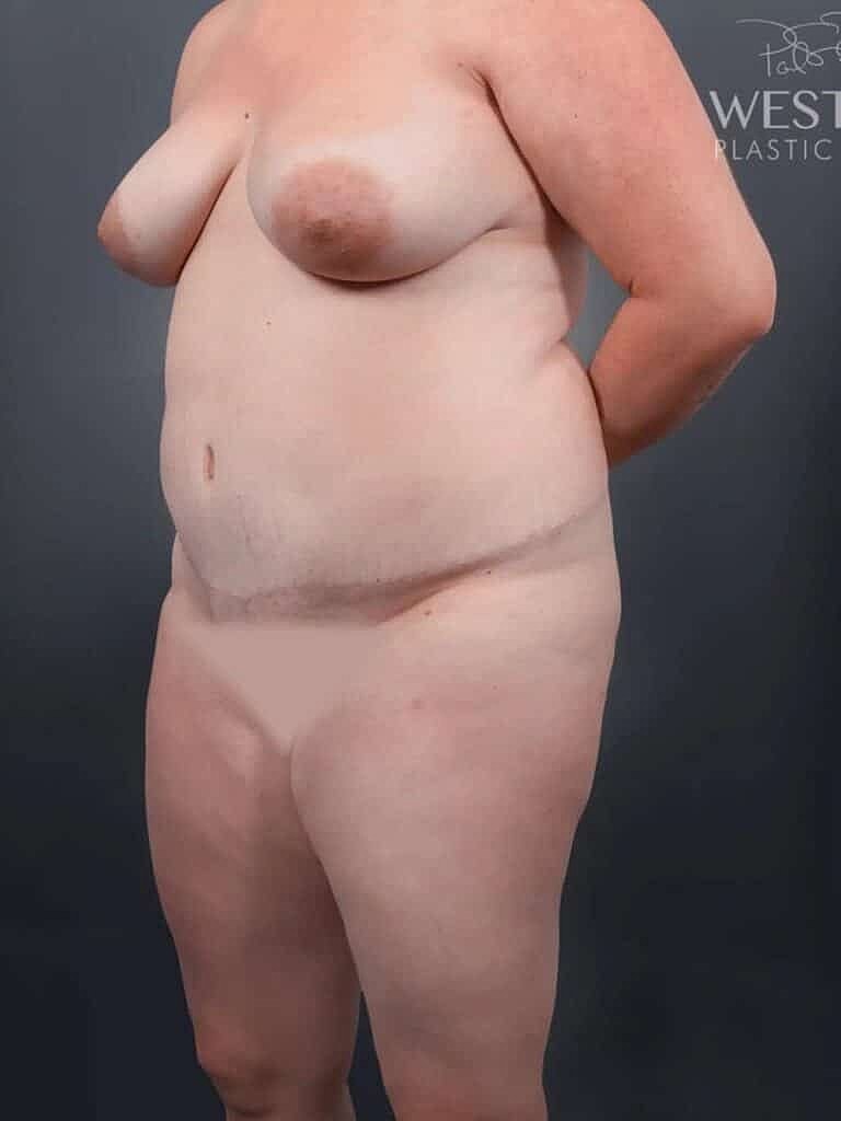 Brazilian Butt Lift Before & After