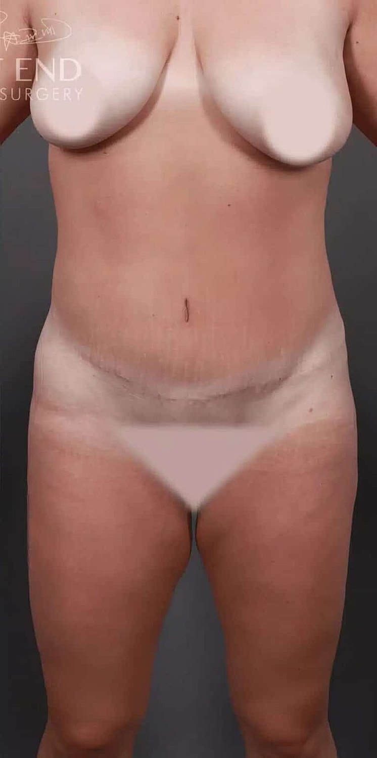 Brazilian Butt Lift Before & After