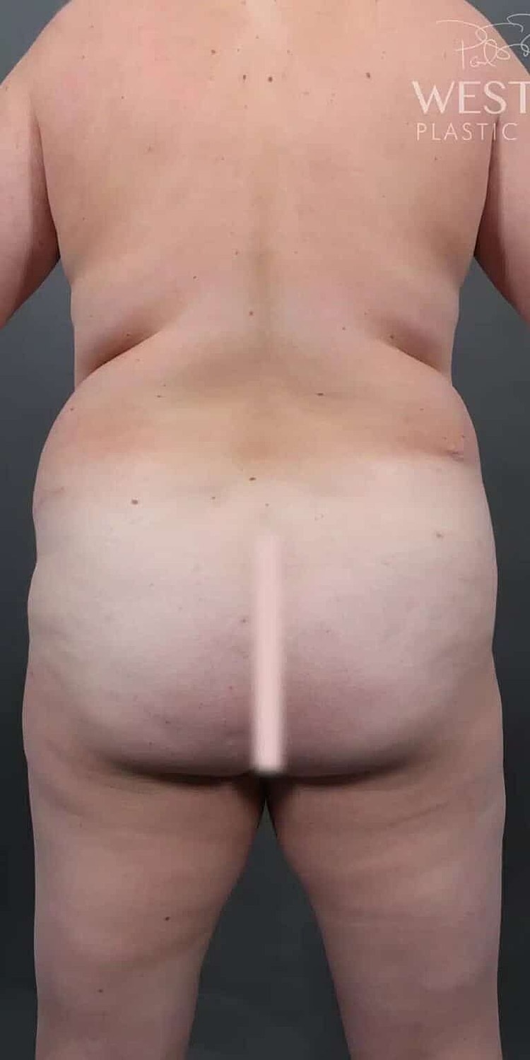 Brazilian Butt Lift Before & After