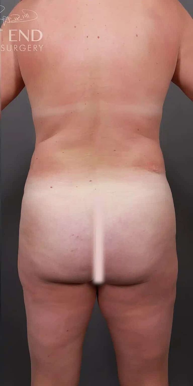 Brazilian Butt Lift Before & After