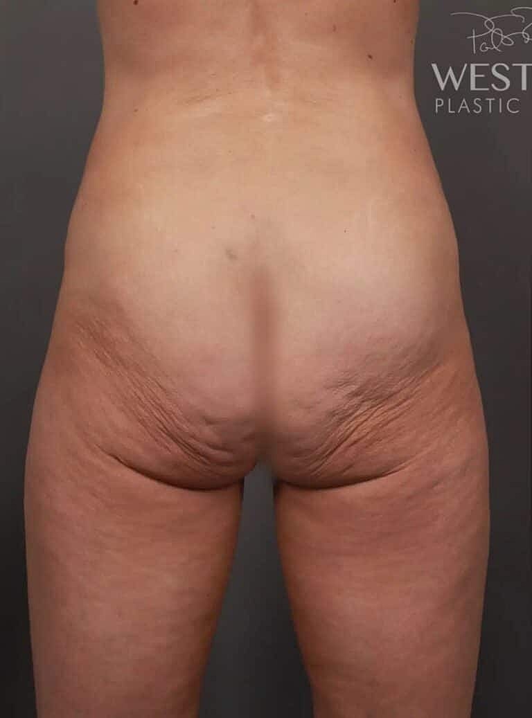 Brazilian Butt Lift Before & After