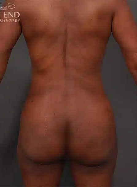 Brazilian Butt Lift Before & After