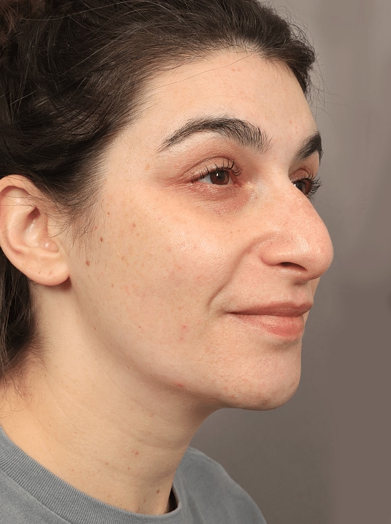 Dermal Fillers Before & After