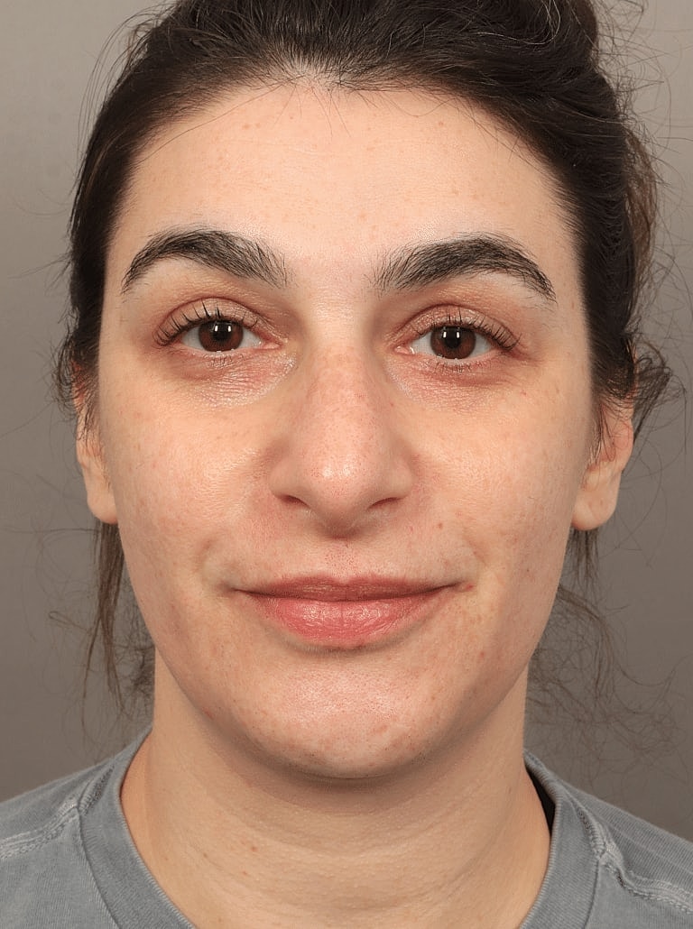 Dermal Fillers Before & After