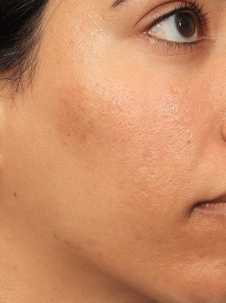 Dermal Fillers Before & After