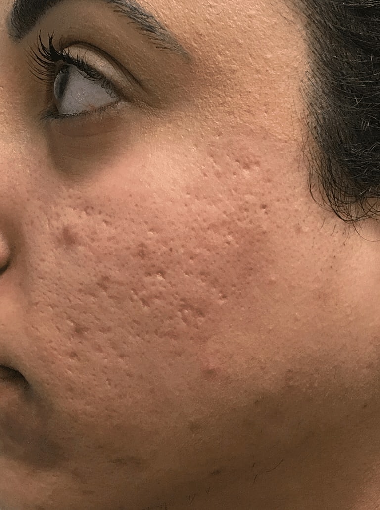 Dermal Fillers Before & After