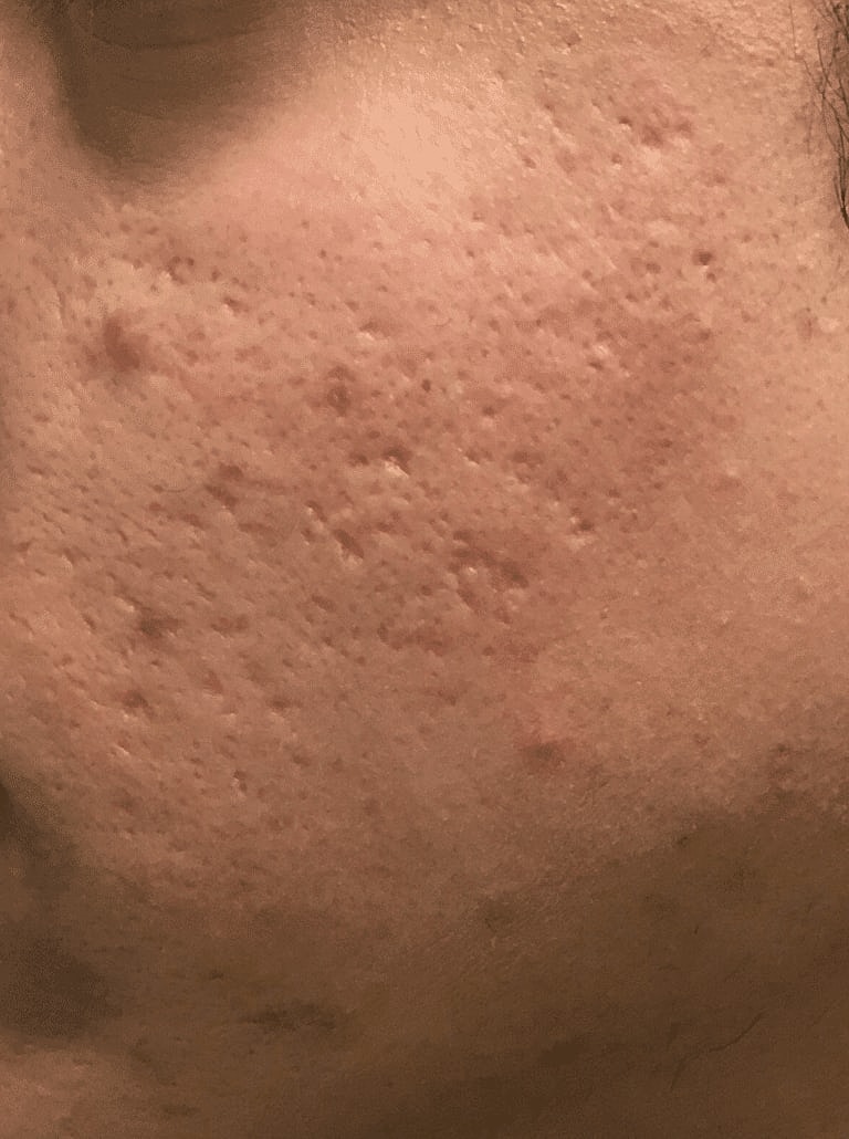 Dermal Fillers Before & After