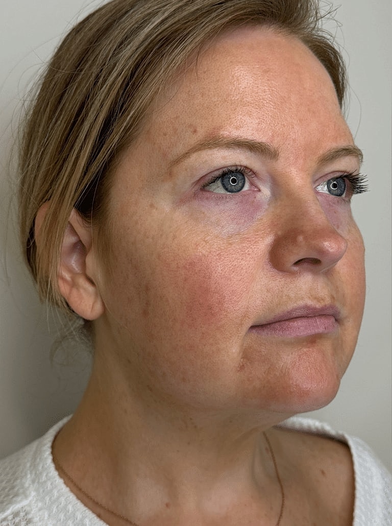 Dermal Fillers Before & After