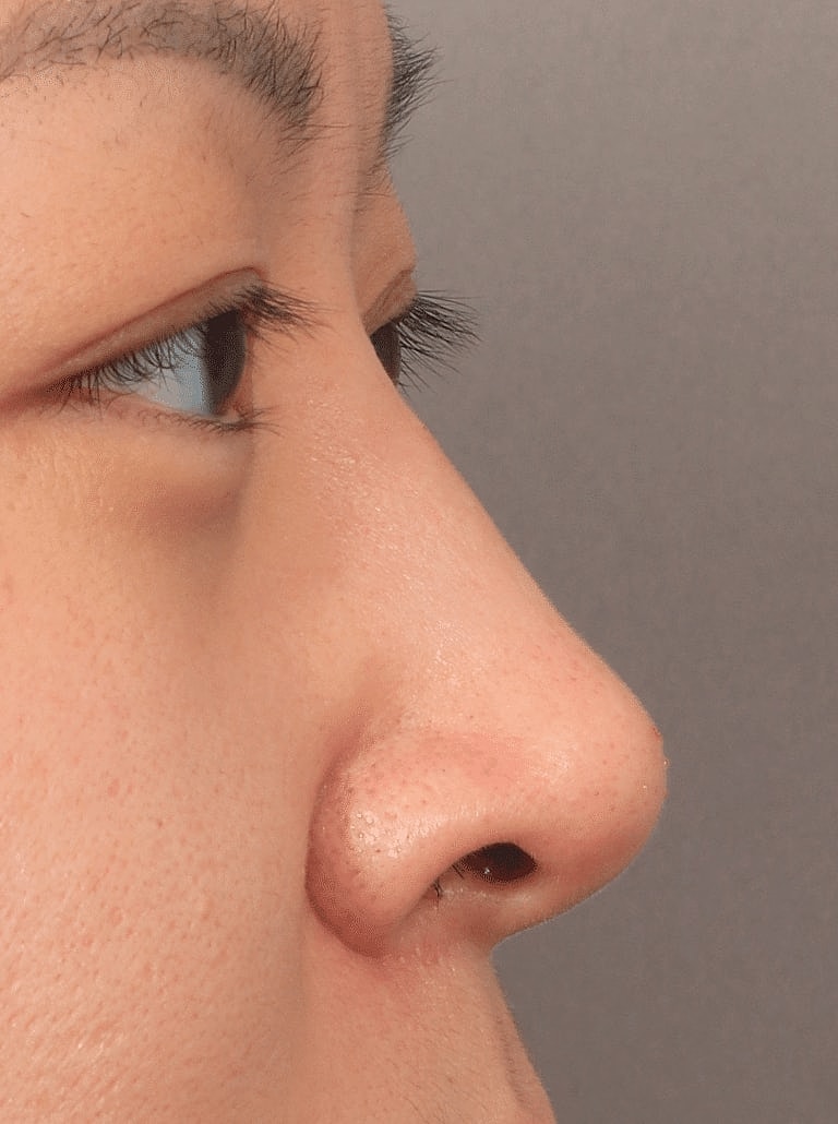 Dermal Fillers Before & After