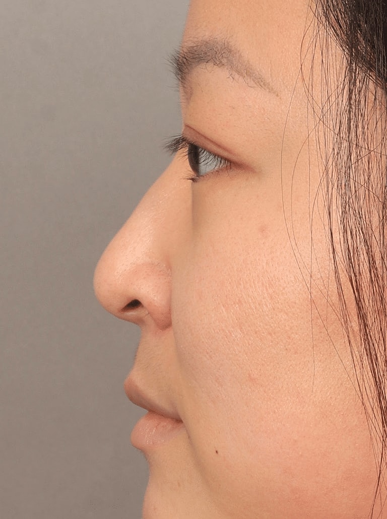 Dermal Fillers Before & After