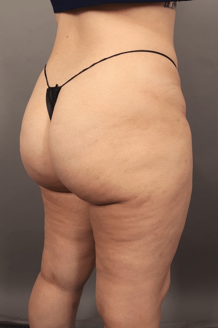 Dermal Fillers Before & After