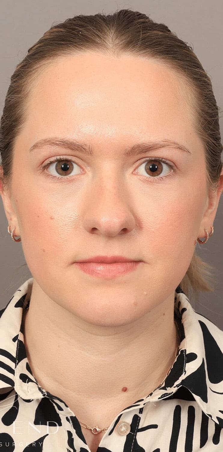 Dermal Fillers Before & After