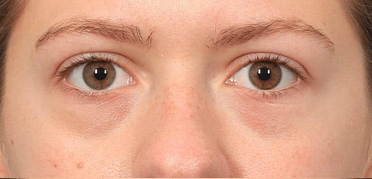 Dermal Fillers Before & After