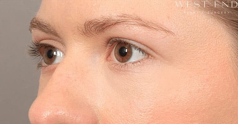 Dermal Fillers Before & After