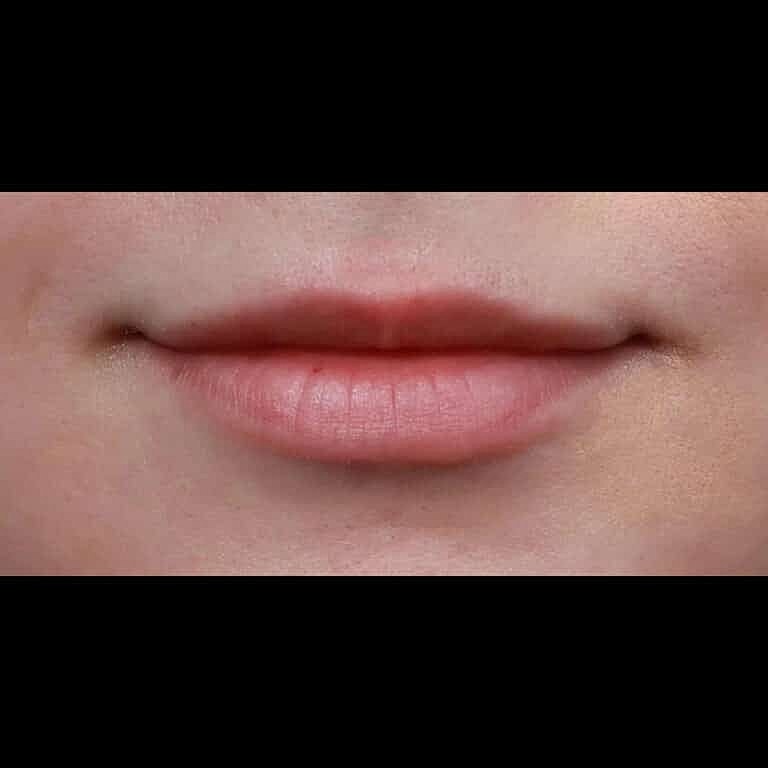 Dermal Fillers Before & After