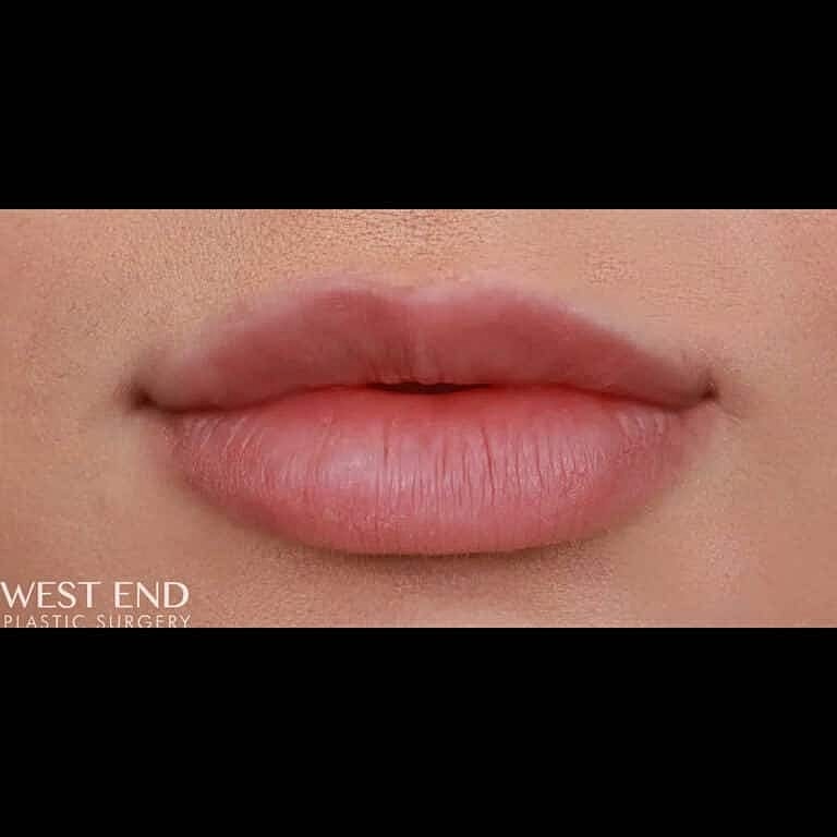Dermal Fillers Before & After