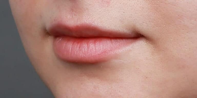Dermal Fillers Before & After