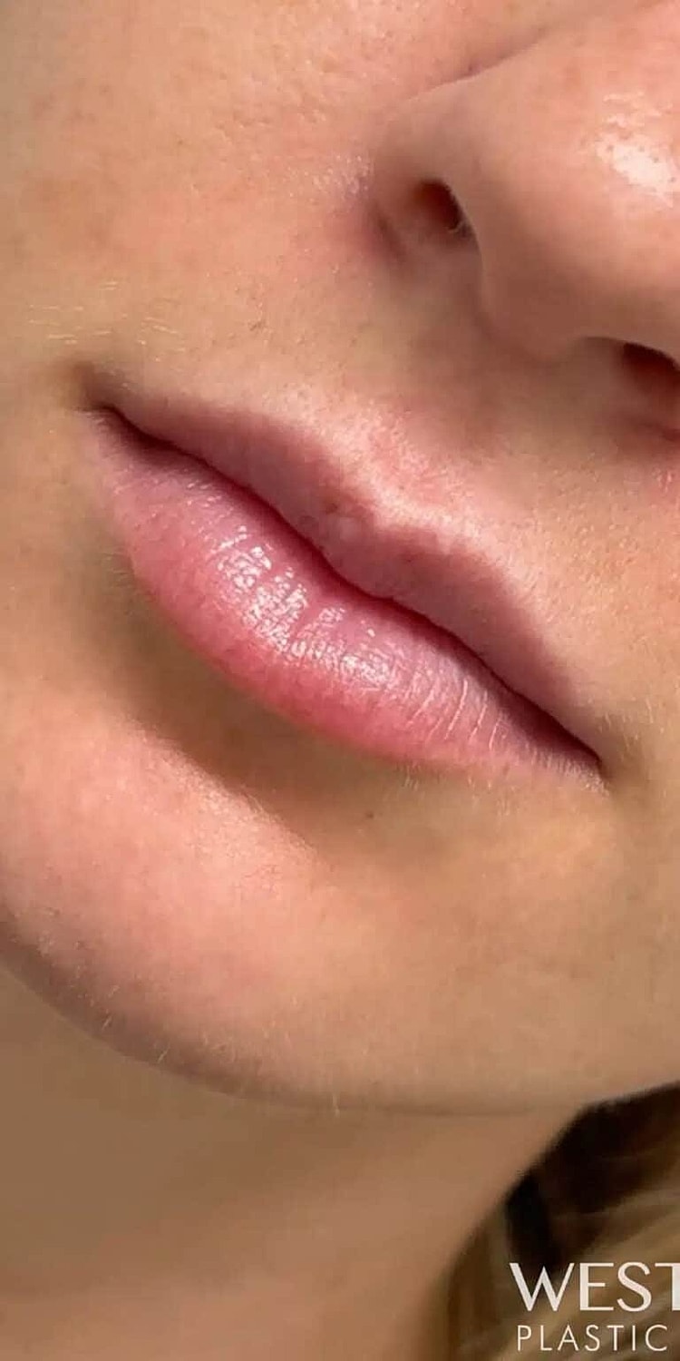 Dermal Fillers Before & After