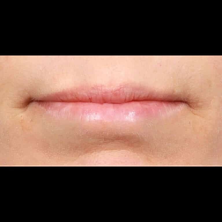 Dermal Fillers Before & After