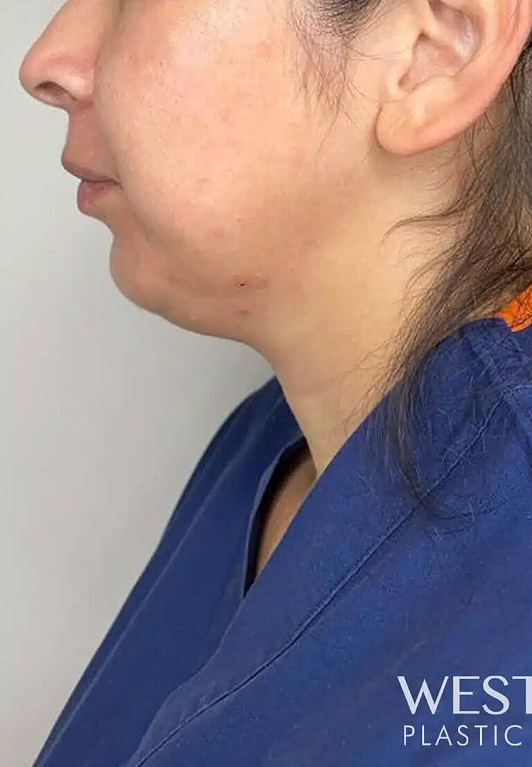Dermal Fillers Before & After