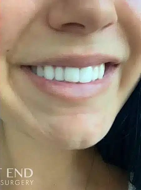 Dermal Fillers Before & After