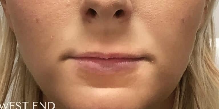 Dermal Fillers Before & After