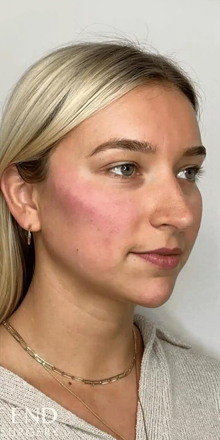 Dermal Fillers Before & After