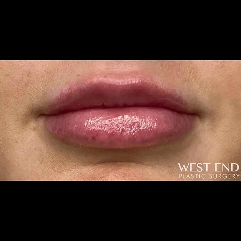 Dermal Fillers Before & After