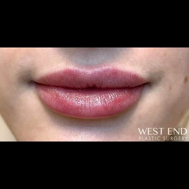 Dermal Fillers Before & After